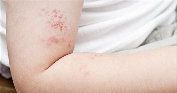 الحزام الناري.. أعراضه وطرق علاجه.. وهؤلاء الأكثر عرضة للإصابة به