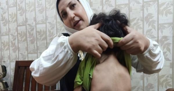 «جسمه بيتحول لعضم لو اتخبط».. متلازمة «الرجل الصخرة» تحرم «محمد» من طفولته
