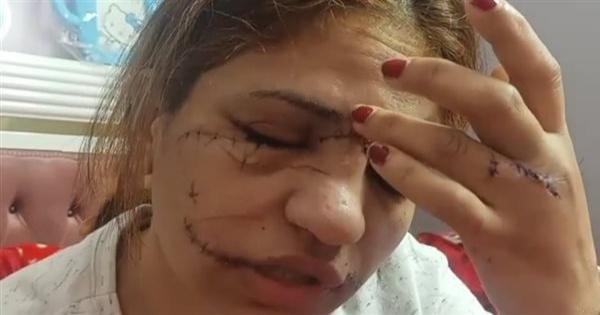زوج يتسبب فى إصابة زوجته بـ240 غرزة فى وجهها (فيديو)