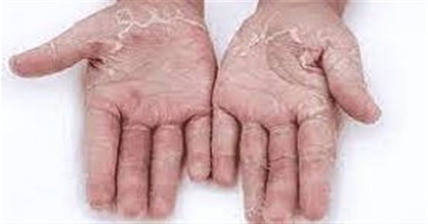 سبب تقشر جلد اليدين.. ما دور المنظفات المنزلية؟