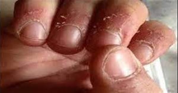 أسباب تقشر الجلد حول الأظافر.. إزالته باليد أو الفم قد تسبب التهابا بكتيريا