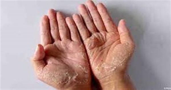 علاج تقشر باطن اليدين.. سينمو الجلد الطبيعي بشكل تلقائي