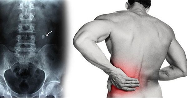 علاج المغص الكلوي بسبب البرد.. عدة مراحل للعلاج
