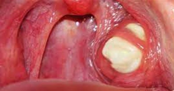 أعراض وعلاج خراج اللوزتين