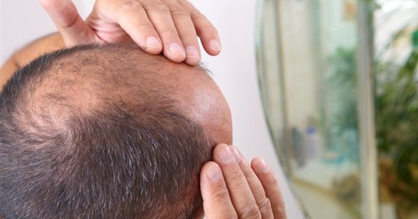 7 مراحل لـ الصلع عند الرجال.. واستشاري يوضح علاقة الهرمونات بتساقط الشعر