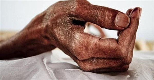 علاج الإيدز.. أستاذ فيروسات يكشف حقنة تمنع انتشار المرض
