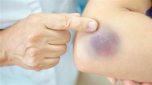 ما هو علاج الكدمات الزرقاء؟.. لا تنم حزينًا