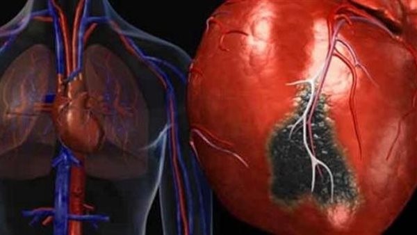 أعراض ومضاعفات سرطان القلب.. واستشاري: مرض نادر الحدوث