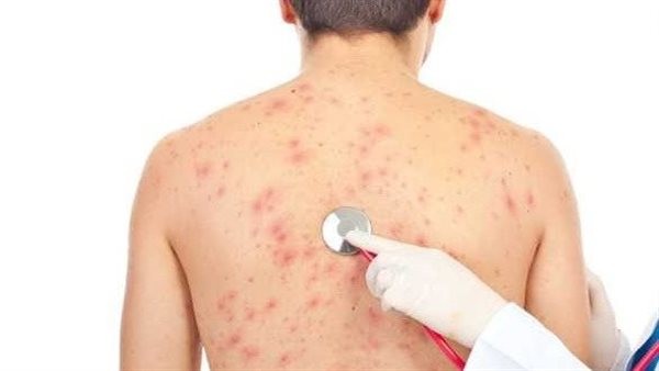 علاج حساسية الجلد نهائيًا.. تحدث مع طبيبك