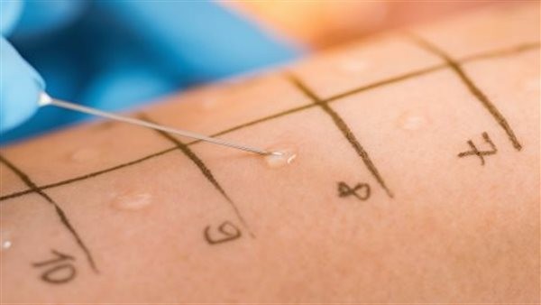 أنواع اختبارات الحساسية.. تعرف على العيوب والمميزات