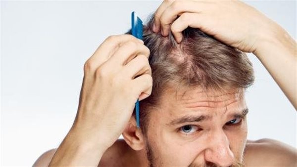 تعرف على أسباب تساقط الشعر عند الشباب وعلاجه