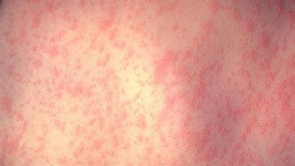 متى تكون حساسية الدم خطيرة؟.. تتطور في دقائق