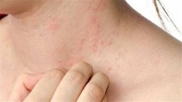 أعراض حساسية القمح.. أخصائي أمراض المناعة يوضح