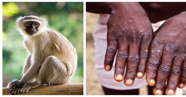 منظمة الصحة العالمية: جدري القردة لن يتحول لوباء مثل كورونا