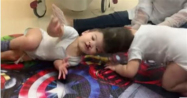 تفاصيل عملية "معقدة" استمرت 27 ساعة لفصل توأم ملتصق الرأس (فيديو)