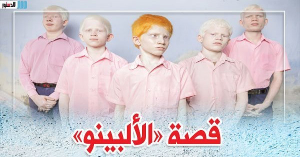 قصة «الألبينو».. «أعداء الشمس»: نار تحرق أجسادهم