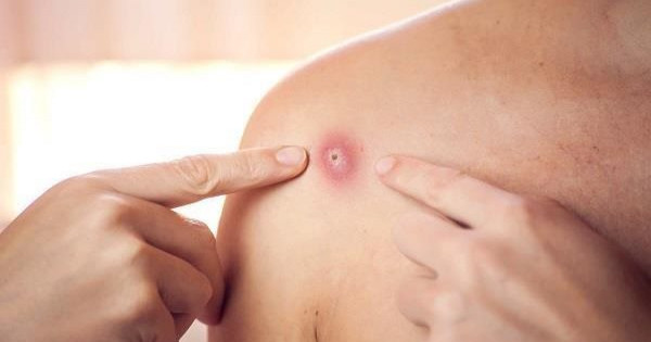الصحة تعلن اكتشاف ثاني إصابة بفيروس جدري القرود في أقل من شهر
