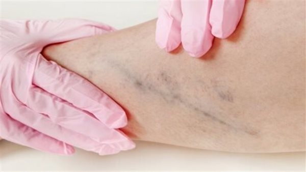 الفرق بين تخثر الدم وتجلط الدم.. لا تهمل الأخير مطلقًا
