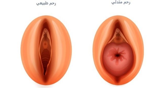 ما هو هبوط الرحم؟.. أخصائي نساء وتوليد تجيب
