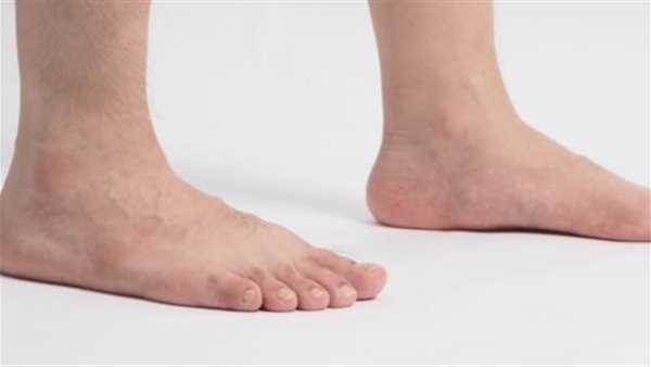 ليس بسبب خُلقي.. ما أسباب الفلات فوت عند الكبار؟