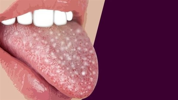 طرق علاج بقع اللسان البيضاء وسبل الوقاية من حدوثها.. هذا ما عليك فعله