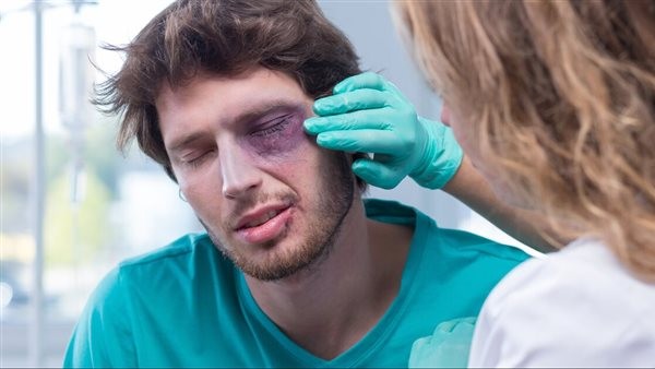 ما علاج الازرقاق تحت العين المضروبة؟.. الجأ إلى طبيبك في حالة الخطر