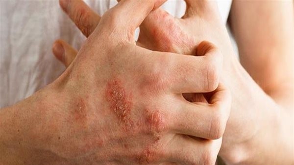 أسباب حساسية الجلد المفاجئة مع حكة.. احذر تناول الكافيين قبل النوم
