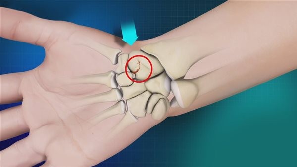 ما هو علاج كسر العظمة الزورقية؟.. بعض الحالات تحتاج إلى مسمار هربرت