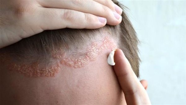 أسباب الإكزيما الدهنية في الشعر.. الوراثة أبرزها