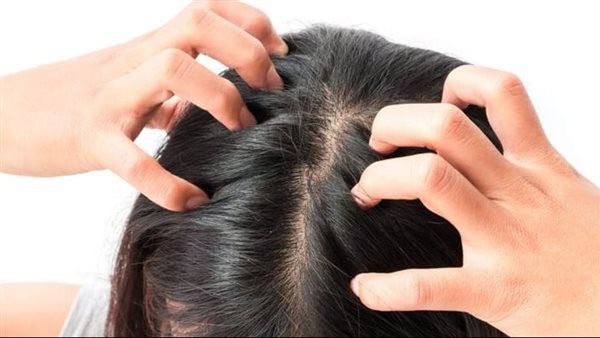 علاج قشرة الشعر نهائيًا.. استشاري يوضح