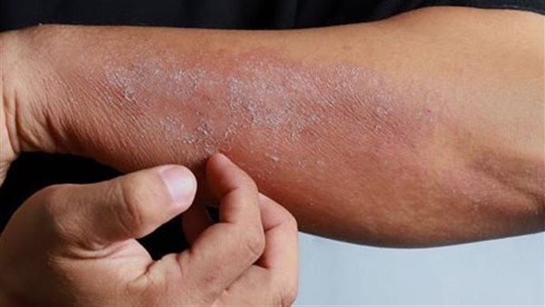 هل مرض الإكزيما مرض خطير؟.. أخصائية جلدية تجيب