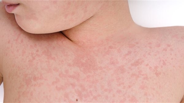 الحمى القرمزية عند الأطفال.. إليكي طرق الوقايةومتى يجب استشارة الطبيب