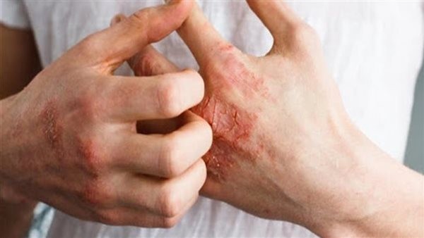 أعراض حساسية الفسيخ.. علامات تظهر على الوجه والفم