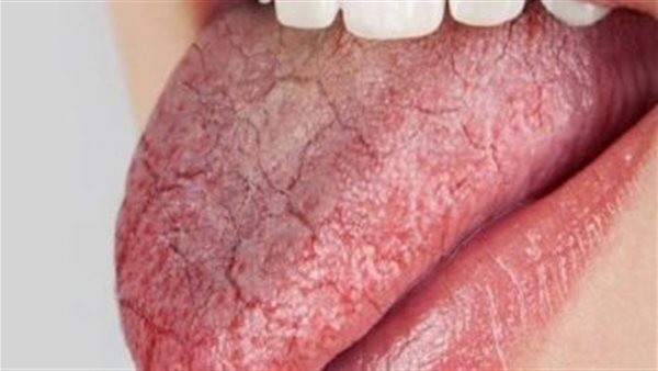 هل مرض بهجت خطير؟.. أخصائي يجيب