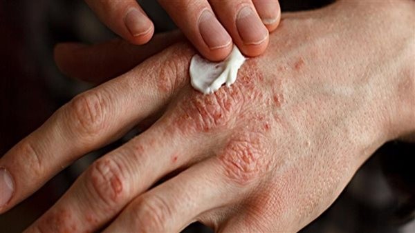 علاج الأكزيما نهائيًا.. تناول مضادات الحساسية والحكة