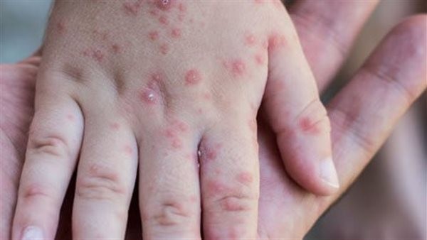 كيف أحمي نفسي من مرض الجدري؟.. اللقاح خير من العلاج