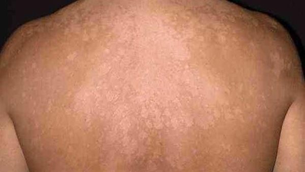 علاج التينيا الملونة.. وهل تعود الفطريات مرة أخرى