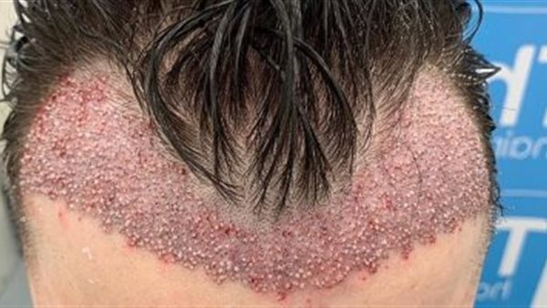 تعرف على أنواع زراعة الشعر والتقنيات الحديثة المستخدمة