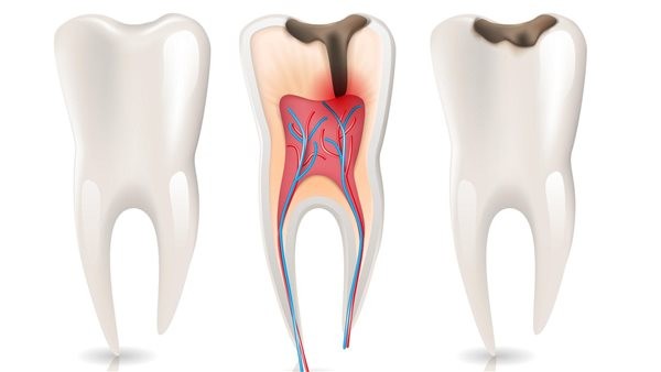 علاج التهاب جذور الأسنان بالأعشاب.. استشاري يحذر
