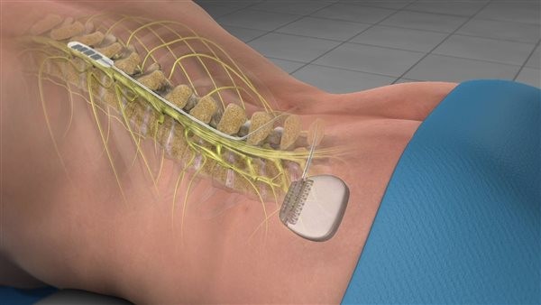 جهاز تحفيز النخاع الشوكي لعلاج الألم.. تعرف على طريقة عمله ومميزاته وعيوبه