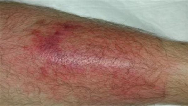 أعراض حمى البحر الأبيض المتوسط... استشاري يوضح