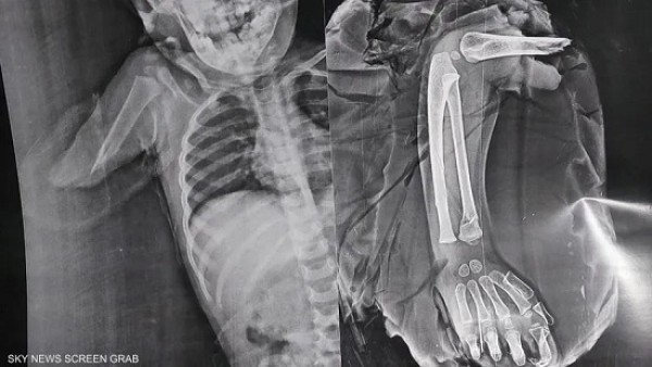 بالتفاصيل.. قصة جراحة صعبة لإعادة ذراع مبتورة لطفلة في مصر