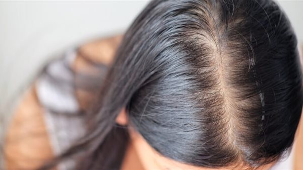 هل حبوب منع الحمل سبب كافٍ لتساقط الشعر عند النساء؟