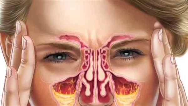 بخاخ الأنف أبرزها.. طرق علاج التهاب الجيوب الأنفية