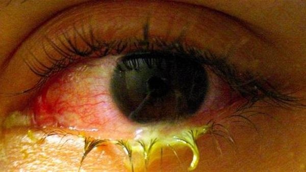 علاج أمراض العين الفيروسية.. طرق متعددة تعرف عليها