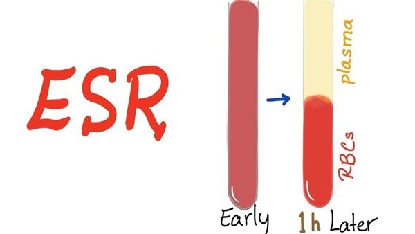 ما الأمراض التي تسبب ارتفاع سرعة الترسيب وهل لها علاج؟