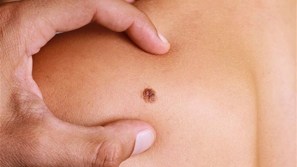 لا ينبغي تجاهلها.. خبراء يحذرون من 6 علامات تبدو على البشرة