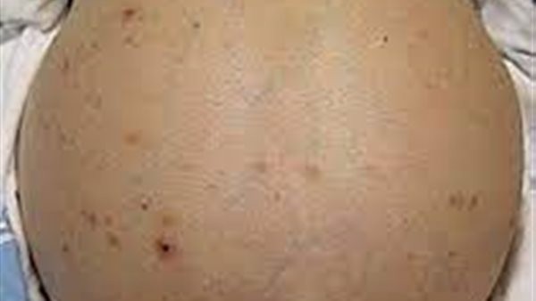 أعراض احتباس السوائل في الجسم.. قد يكون في الدماغ أو البطن فضلا عن القدمين