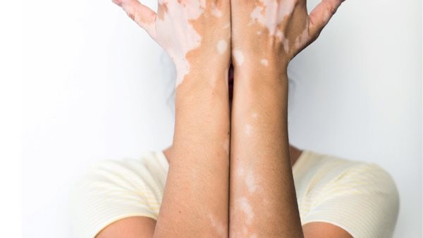 الفرق بين بقع الجسم البيضاء والبهاق.. أخصائي جلدية يوضح