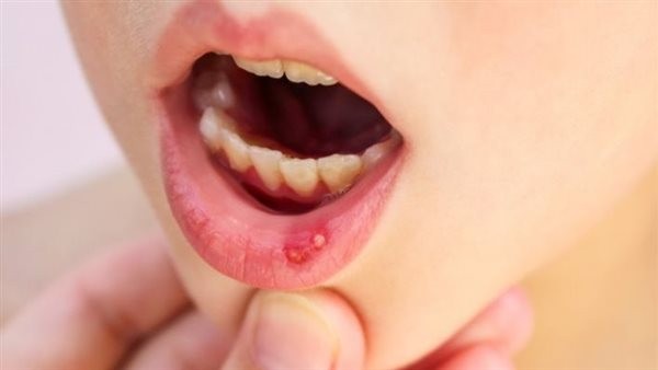 هيئة الدواء توضح خطورة الإصابة بفيروس الهربس